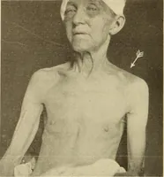Picture 11 of 481 from Fractures and dislocations, diagnosis and treatment (1915), leaf 51