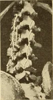 An illustration from Fractures and dislocations, diagnosis and treatment (1915)