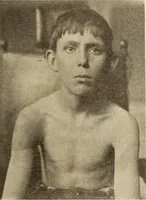 An illustration from Fractures and dislocations, diagnosis and treatment (1915)