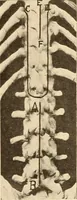 Picture 311 of 481 from Fractures and dislocations, diagnosis and treatment (1915), leaf 520