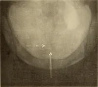 An illustration from Fractures and dislocations, diagnosis and treatment (1915)