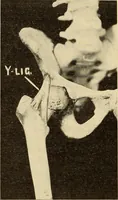 Picture 316 of 481 from Fractures and dislocations, diagnosis and treatment (1915), leaf 547