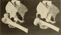An illustration from Fractures and dislocations, diagnosis and treatment (1915)