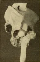 Picture 319 of 481 from Fractures and dislocations, diagnosis and treatment (1915), leaf 549