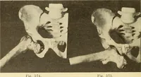 Picture 320 of 481 from Fractures and dislocations, diagnosis and treatment (1915), leaf 549