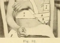 An illustration from Fractures and dislocations, diagnosis and treatment (1915)