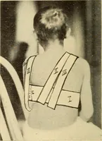 Picture 20 of 481 from Fractures and dislocations, diagnosis and treatment (1915), leaf 55