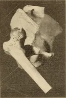 Picture 321 of 481 from Fractures and dislocations, diagnosis and treatment (1915), leaf 550