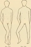 An illustration from Fractures and dislocations, diagnosis and treatment (1915)