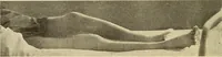 An illustration from Fractures and dislocations, diagnosis and treatment (1915)