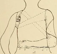 An illustration from Fractures and dislocations, diagnosis and treatment (1915)