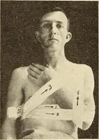 Picture 22 of 481 from Fractures and dislocations, diagnosis and treatment (1915), leaf 56