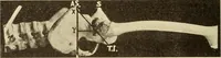 An illustration from Fractures and dislocations, diagnosis and treatment (1915)