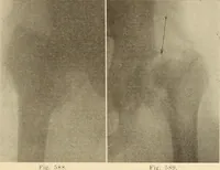 Picture 326 of 481 from Fractures and dislocations, diagnosis and treatment (1915), leaf 566