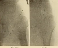 Picture 327 of 481 from Fractures and dislocations, diagnosis and treatment (1915), leaf 566