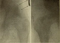 Picture 328 of 481 from Fractures and dislocations, diagnosis and treatment (1915), leaf 567