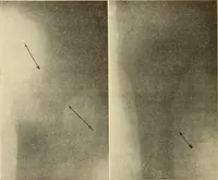 An illustration from Fractures and dislocations, diagnosis and treatment (1915)