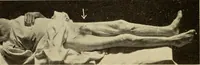 Picture 330 of 481 from Fractures and dislocations, diagnosis and treatment (1915), leaf 569