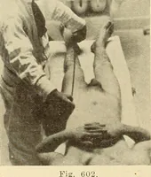 Picture 332 of 481 from Fractures and dislocations, diagnosis and treatment (1915), leaf 571