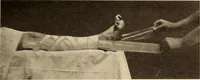 An illustration from Fractures and dislocations, diagnosis and treatment (1915)