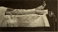 An illustration from Fractures and dislocations, diagnosis and treatment (1915)
