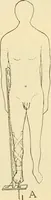 An illustration from Fractures and dislocations, diagnosis and treatment (1915)