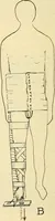 An illustration from Fractures and dislocations, diagnosis and treatment (1915)