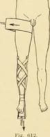 An illustration from Fractures and dislocations, diagnosis and treatment (1915)