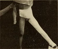An illustration from Fractures and dislocations, diagnosis and treatment (1915)