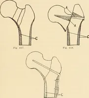 An illustration from Fractures and dislocations, diagnosis and treatment (1915)