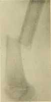 An illustration from Fractures and dislocations, diagnosis and treatment (1915)