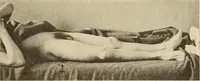 An illustration from Fractures and dislocations, diagnosis and treatment (1915)