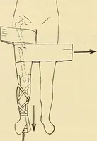 An illustration from Fractures and dislocations, diagnosis and treatment (1915)