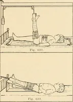 An illustration from Fractures and dislocations, diagnosis and treatment (1915)