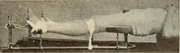Picture 353 of 481 from Fractures and dislocations, diagnosis and treatment (1915), leaf 600
