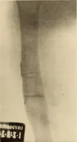 An illustration from Fractures and dislocations, diagnosis and treatment (1915)