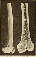 Picture 355 of 481 from Fractures and dislocations, diagnosis and treatment (1915), leaf 606