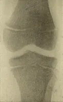 Picture 356 of 481 from Fractures and dislocations, diagnosis and treatment (1915), leaf 607