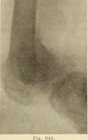 Picture 357 of 481 from Fractures and dislocations, diagnosis and treatment (1915), leaf 608