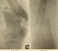 Picture 358 of 481 from Fractures and dislocations, diagnosis and treatment (1915), leaf 608