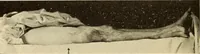 An illustration from Fractures and dislocations, diagnosis and treatment (1915)