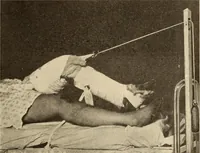 An illustration from Fractures and dislocations, diagnosis and treatment (1915)
