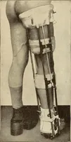 An illustration from Fractures and dislocations, diagnosis and treatment (1915)