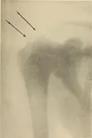 Picture 24 of 481 from Fractures and dislocations, diagnosis and treatment (1915), leaf 62