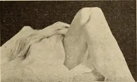 An illustration from Fractures and dislocations, diagnosis and treatment (1915)