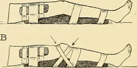 An illustration from Fractures and dislocations, diagnosis and treatment (1915)