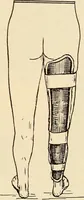 An illustration from Fractures and dislocations, diagnosis and treatment (1915)