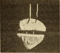An illustration from Fractures and dislocations, diagnosis and treatment (1915)
