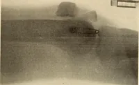 An illustration from Fractures and dislocations, diagnosis and treatment (1915)