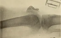Picture 373 of 481 from Fractures and dislocations, diagnosis and treatment (1915), leaf 632